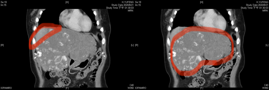 (左圖)病人正常的肝臟範圍/(右圖)病人病灶的肝臟範圍