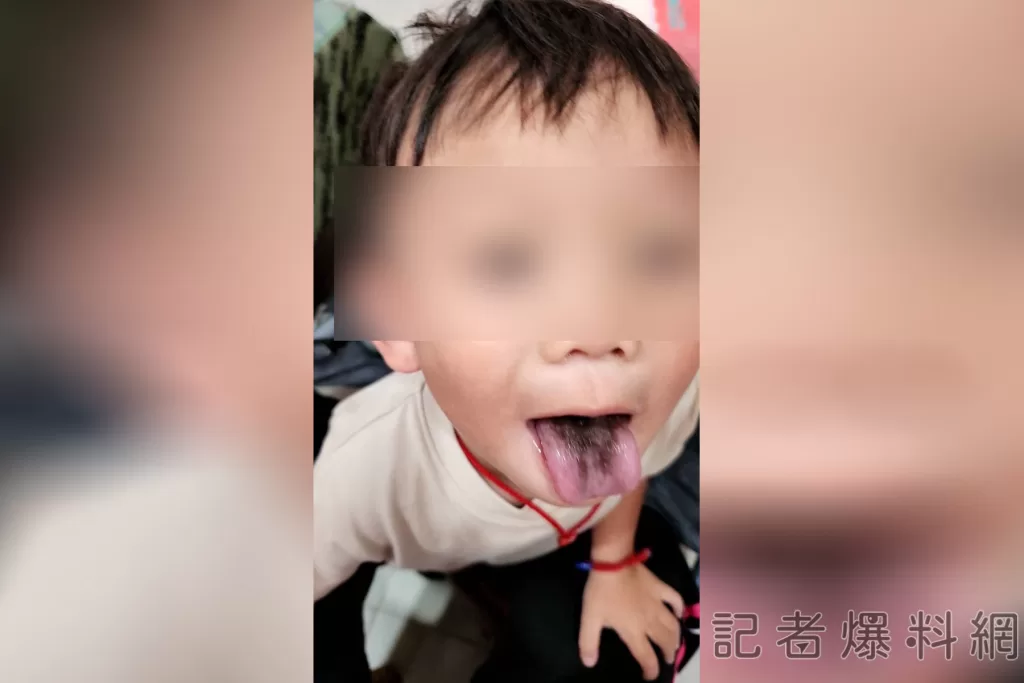 4歲男童口服10天抗生素　口腔赫見「黑毛舌」嚇壞媽媽